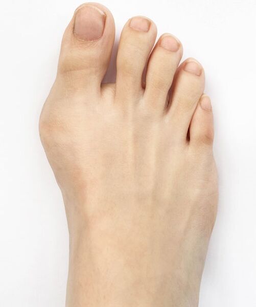 Hallux valgus vor der Anwendung des Hondro Sol Valgus-Sprays