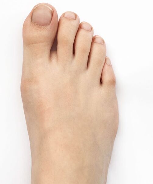 Ich habe meinen Daumen-Valgus mit Hondro Sol Valgus-Spray geheilt
