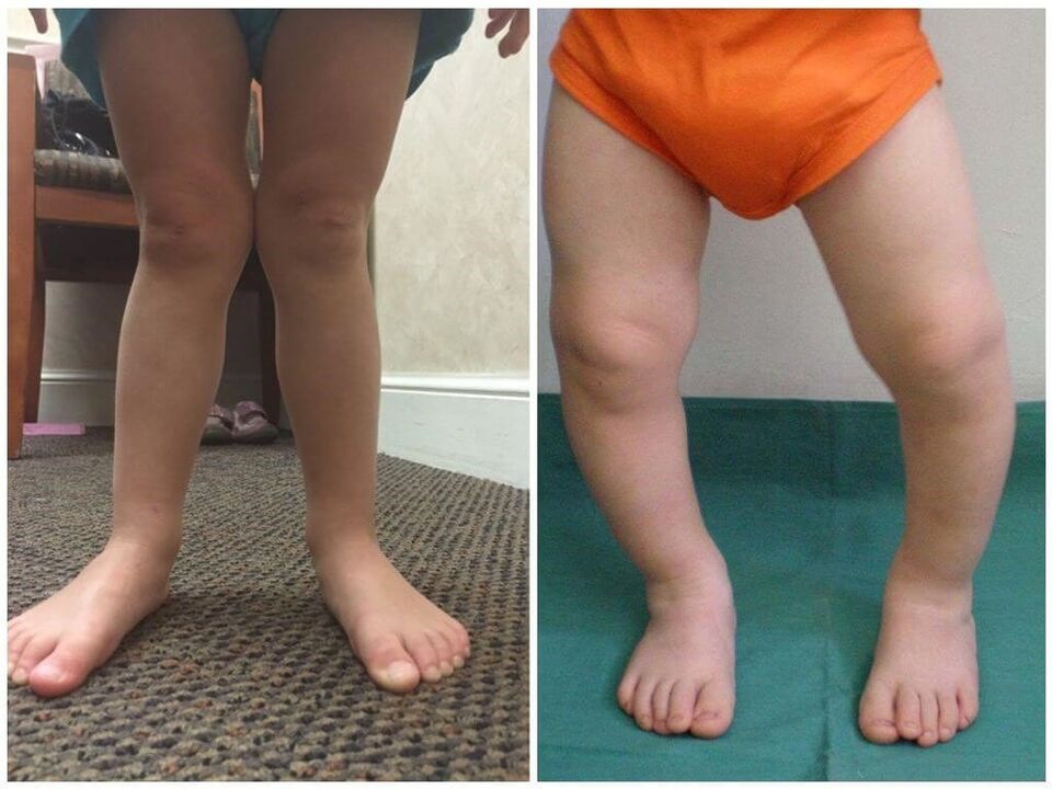 Valgo -Deformation bei Kindern Ursachen