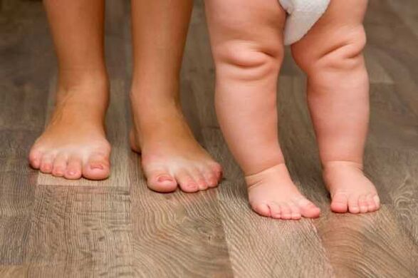 Valgo -Deformation bei Kindern