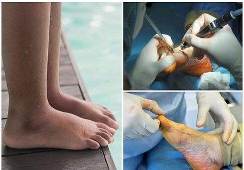 Kleine invasive chirurgische Behandlung