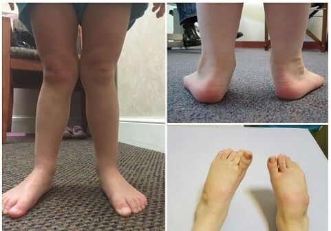 Valgo -Deformation bei Kindern