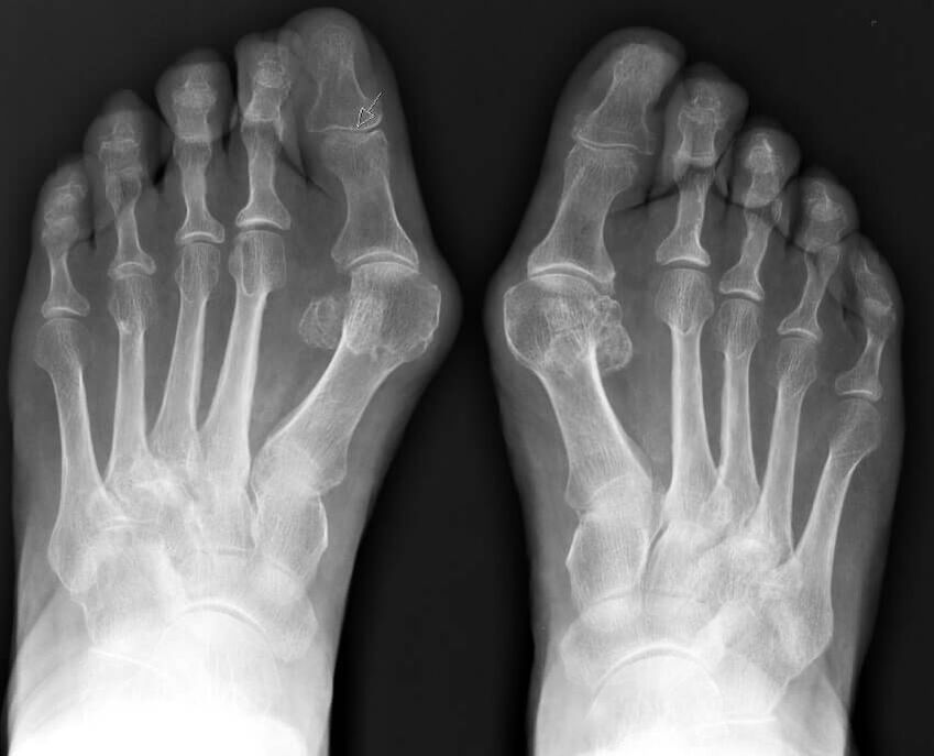 Hallux-valgus-Röntgenaufnahme